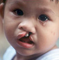 Operation Smile