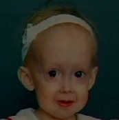 Look at her head. She was bald since her childhood (Film Incredible Medical Mysteries: Growing Up Old)