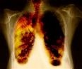 <a href=http://msnbcmedia3.msn.com/j/msnbc/Sections/Newsweek/Components/Photos/Mag/050822_Issue/050813_Lung_hsmall.widec.jpg>How smoking affects your lungs</a>