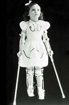 A young girl with poliomyelitis. (http://www.healthgiants.com/wp-content/uploads/2009/12/polio.jpg)