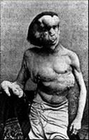 Joseph John  Merrick and his  deformations (This picture is shown in the famous website 