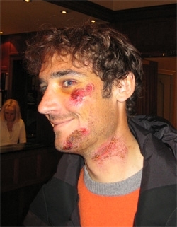 Road rash from the 2006 Tour of Flanders (http://www.thepaceline.com/members/staff_report_item.aspx?cid=2159)