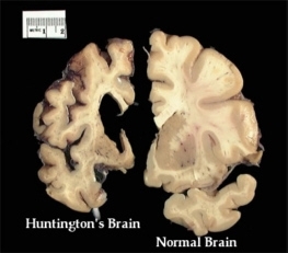 Huntington's Brain vs. Normal Brain (http://hdroster.iu.edu/AboutHD/Images/piHDvC.jpg)