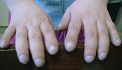 Clubbing Fingers (Wikipedia Commons)